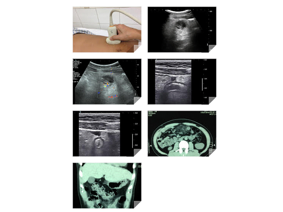 Vietnamese Medic Ultrasound Case 389 Ectopic Appendicitis Dr Phan