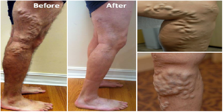 Kamu Cukup Kompres Pake Ini Urat Varises Bisa Hilang dalam 7 Hari