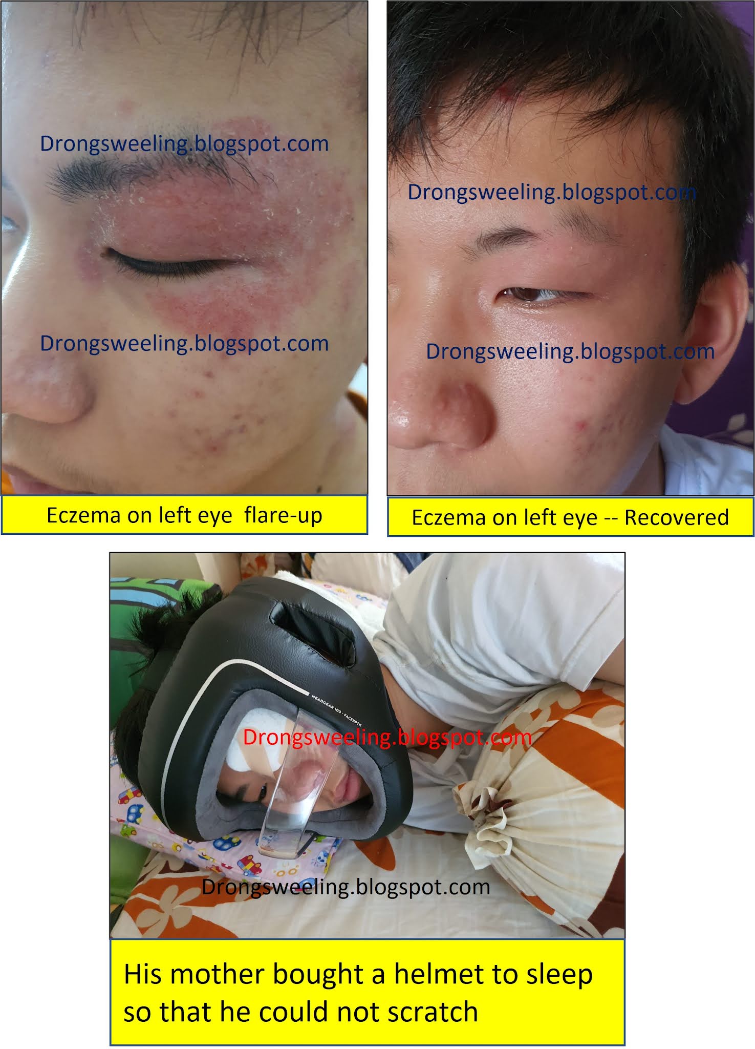 TCM News TCM Treatment for Eczema, Atopic Dermatitis, Psoriasis. Best