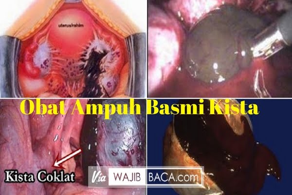 Bunda Perlu Tahu, ini Obat Tradisional yang Ampuh Basmi Bunda Perlu Tahu, ini Obat Tradisional yang Ampuh Basmi