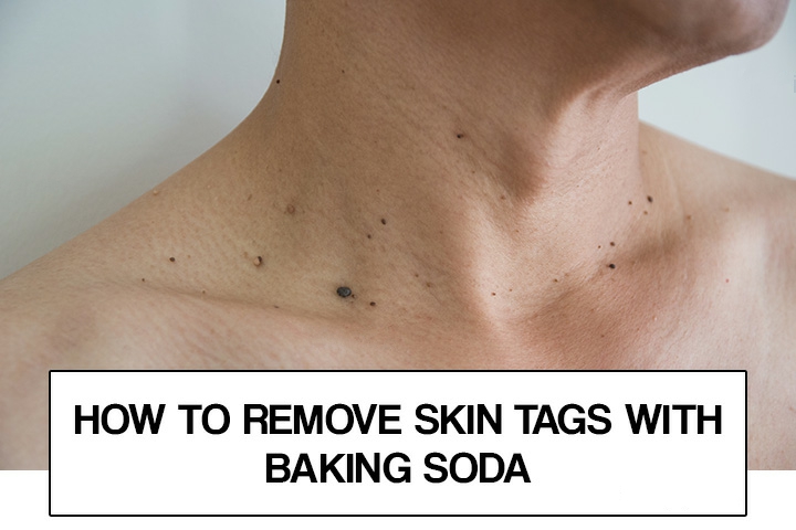 Does Castor Oil Remove Skin Tags How to Remove Skin Tags With Baking Soda and Castor Oil - Healthy Food