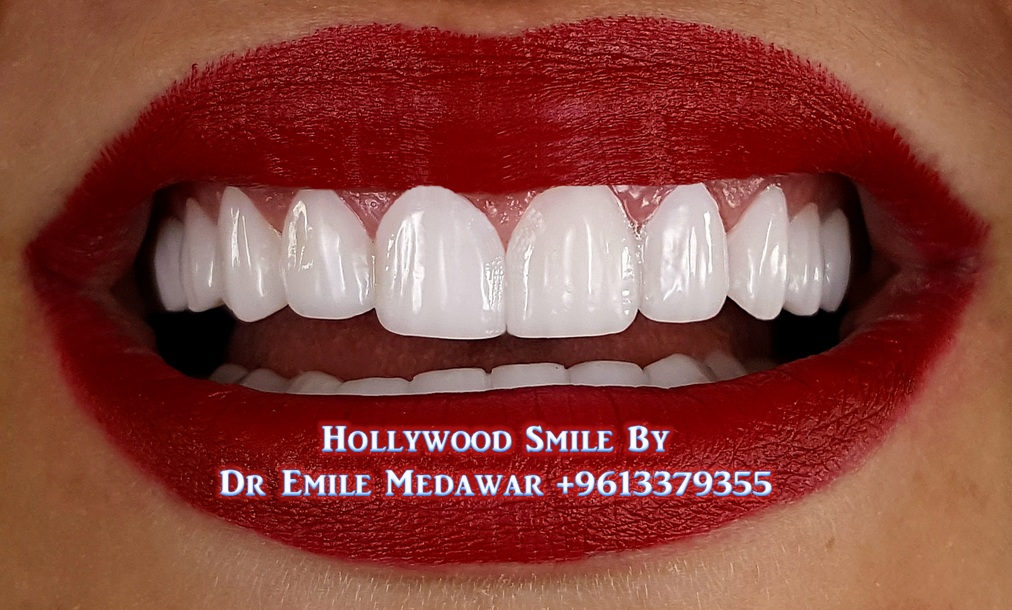 Smiles, Dr Emile Medawar, 00961 3 379355 Perfect ultrathin Digital