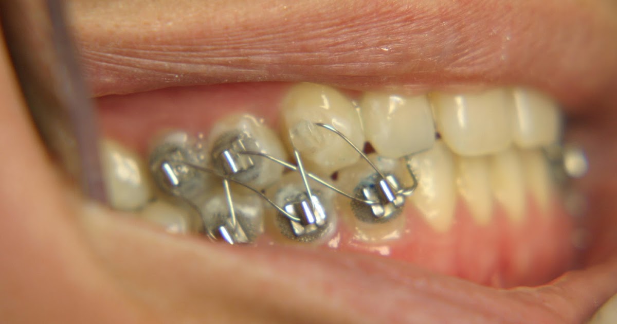 How Long Does Jaw Wiring Surgery Take