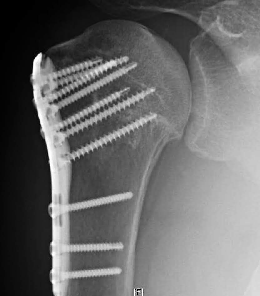 Shoulder Arthritis / Rotator Cuff Tears / Shoulder Pain Severe post traumatic arthritis