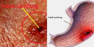 obat tukak lambung alami