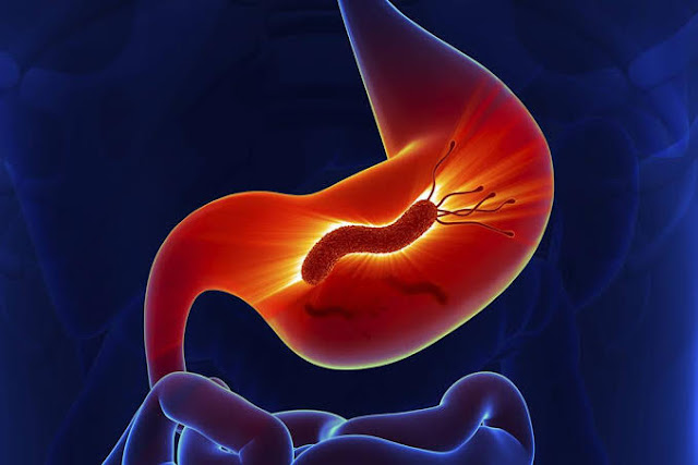 علاج جرثومة المعدة