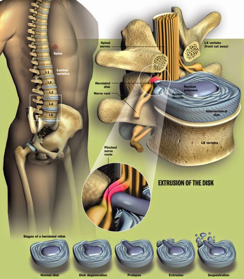 electrostimulare hernie de disc