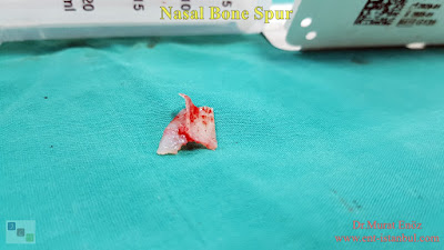 Nasal Bone Spur