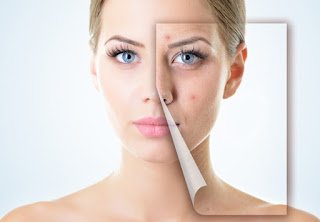 10 Highly Effective Treatment For Adult Acne