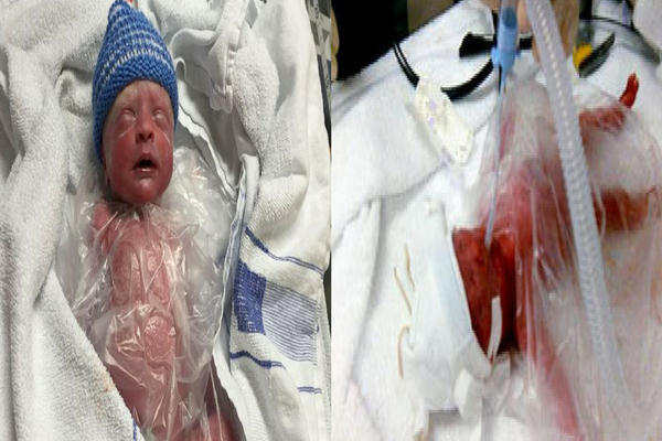 Keajaiban, Bayi Lahir Prematur dengan Berat 700gram Selamat Berkat Kantong Plastik