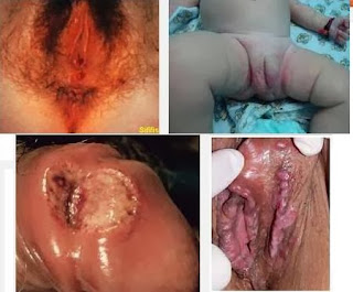 Obat Ampuh Penyakit Sipilis Raja Singa Obat Ampuh Penyakit Sipilis Raja Singa