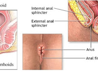Menghilangkan Wasir Luar Secara Alami