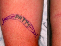 Does Tattoo Removal Scar Does Tattoo Removal Scar