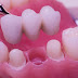 Phương pháp làm răng giả nguyên hàm cố định