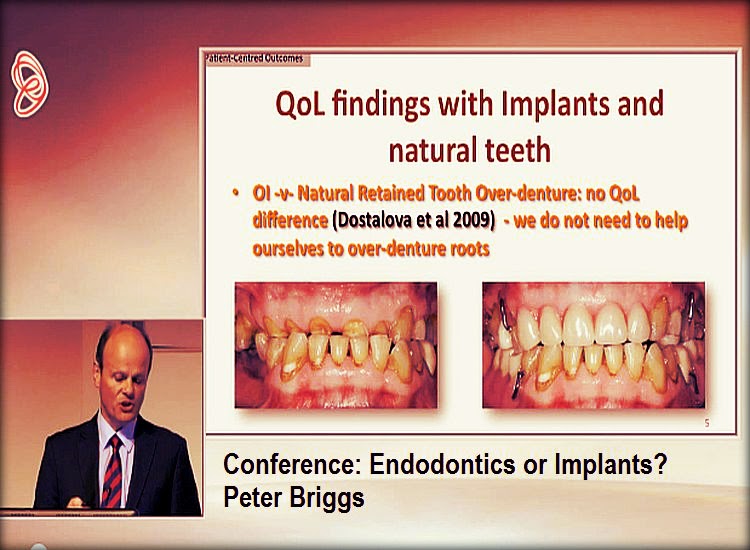 VIDEOCONFERENCING Endodontics or Implants? Peter Briggs