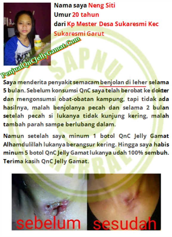 Obat Benjolan Di Selangkangan Paha Tradisional ,TERBUKTI Manjur!! Obat Benjolan Di Selangkangan Paha Tradisional ,TERBUKTI Manjur!!
