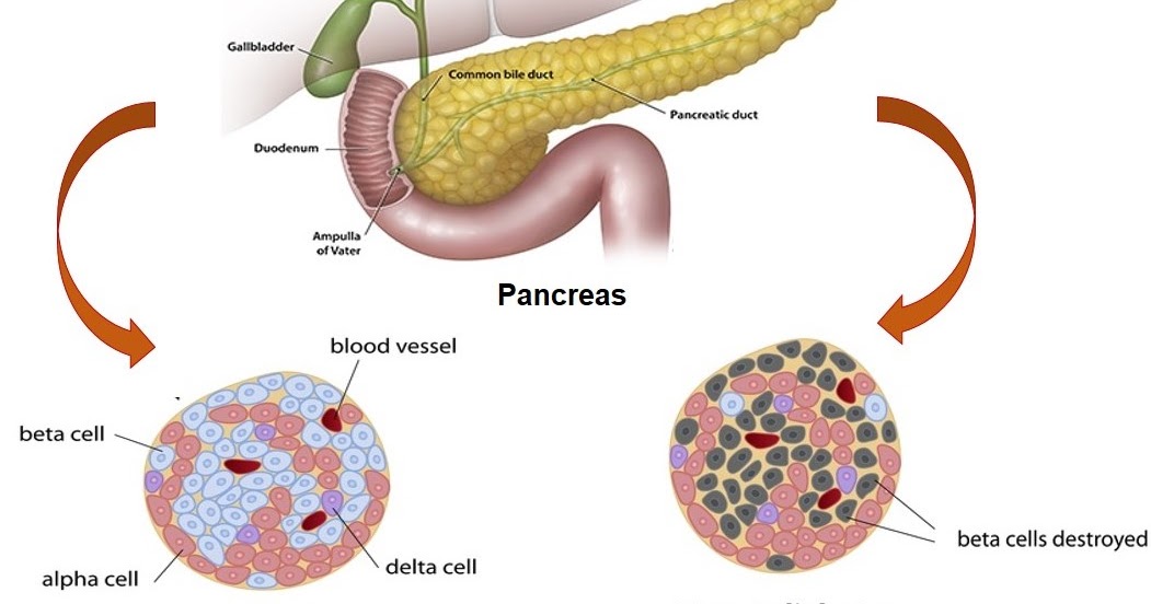 Type 1 Diabetes Take Insulin everyday to stay alive