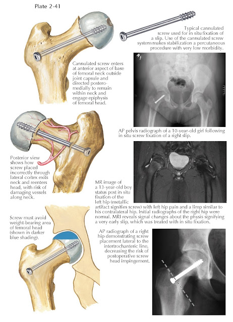 PIN FIXATION IN SLIPPED CAPITAL FEMORAL EPIPHYSIS