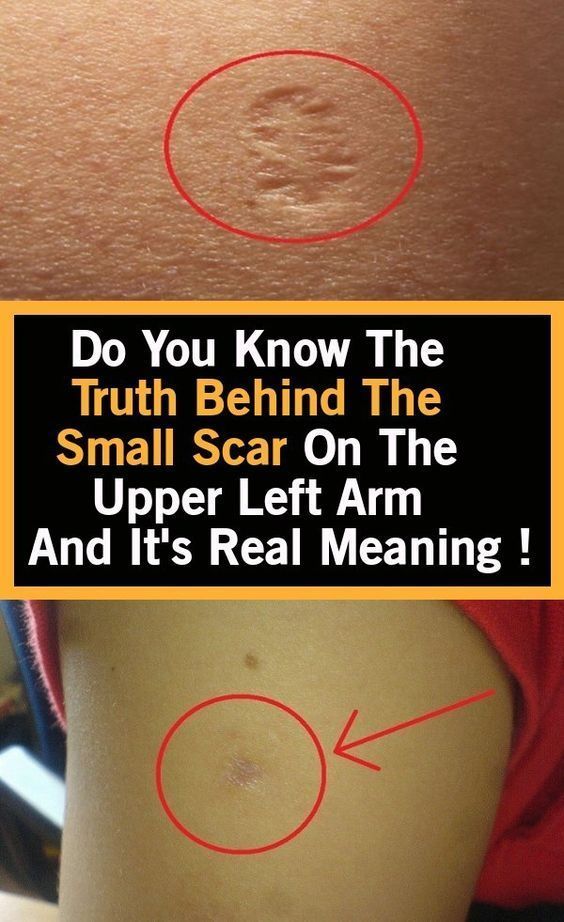 This Is The Truth Behind The Scar Everyone Has On The Upper Left Arm Wellness Magazine