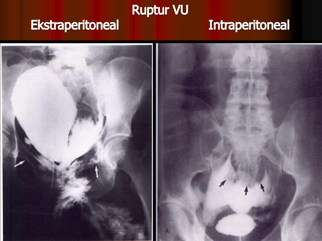 hpv és medence