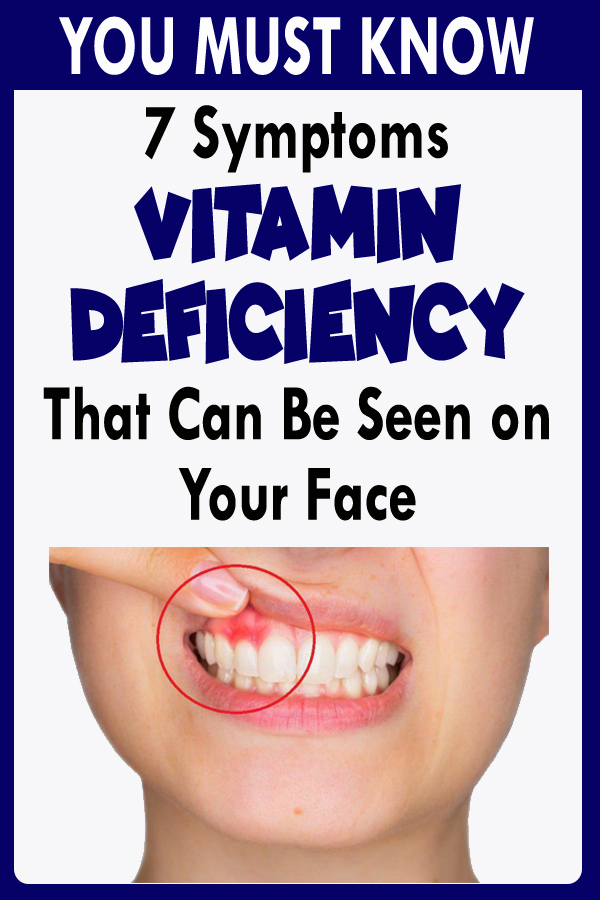 Vitamin Deficiency 7 Symptoms That Can Be Seen on Your Face