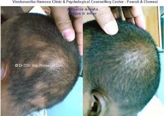  Alopecia Areata,  புழு வெட்டு