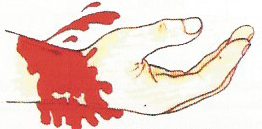 Perdarahan terjadi akhir dari rusaknya dinding pembuluh darah yang sanggup disebabkan oleh  Perdarahan & Syok