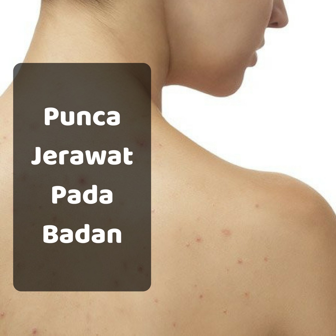 Punca Jerawat Belakang Badan Mbh Beauty Academy