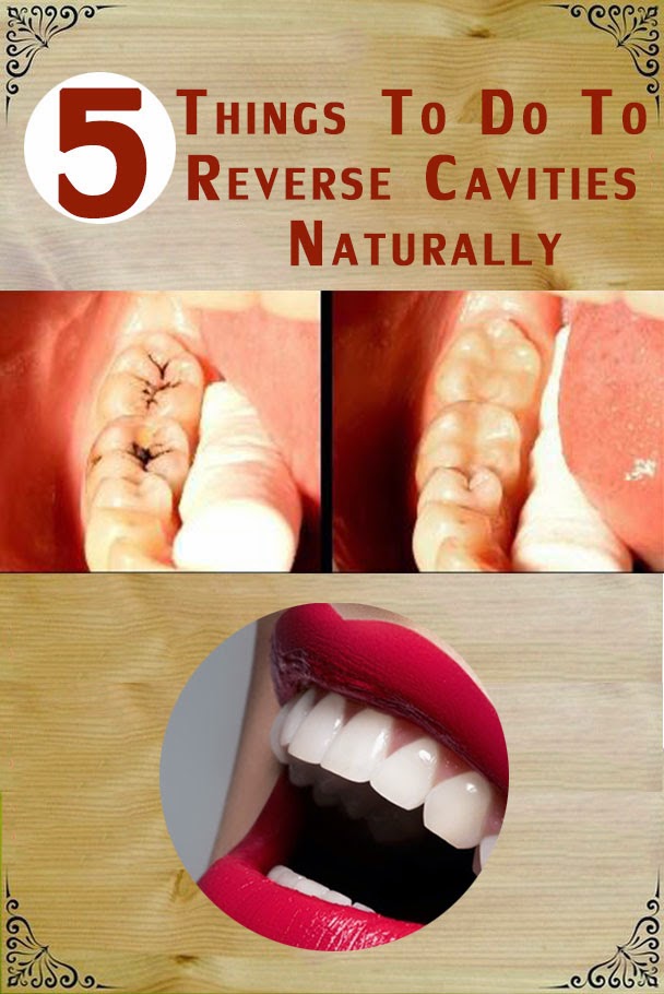 Natural Tooth Whitening Ideas 5 things to do to Reverse Cavities Naturally