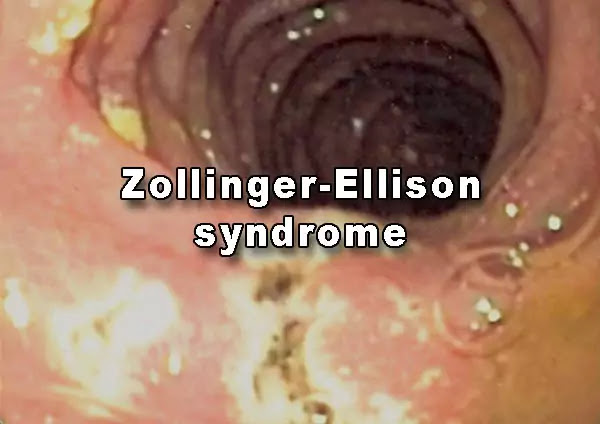 Zollinger Ellison syndrome or gastrinoma