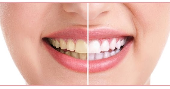 Quais alimentos mancham os dentes? - Saber Atualizado