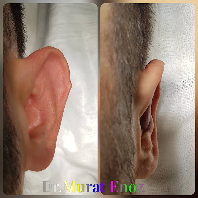 Otoplasty Operation For Protruding Ears in Istanbul