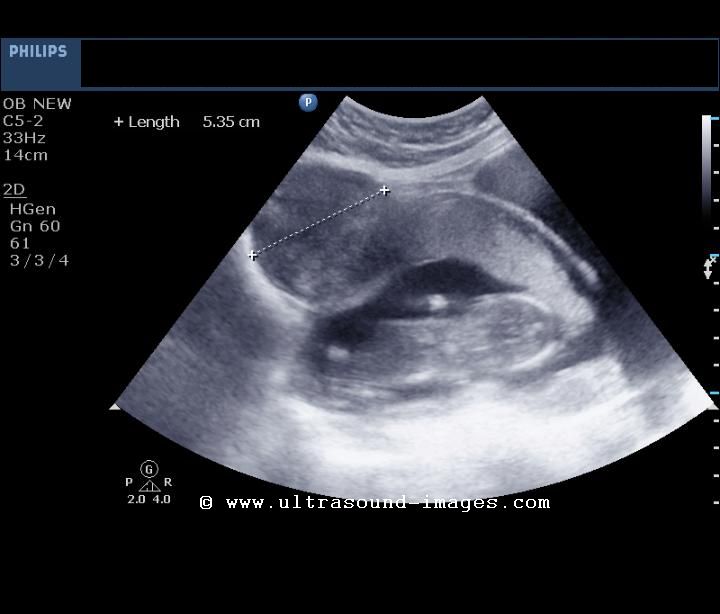 fibroid-pregnancy-1a.jpg
