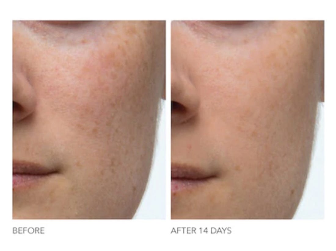 This helps with pimples from the sun Confuse