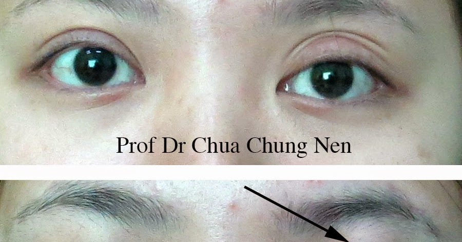 Eyelid Surgery by Prof Dr CN CHUA 蔡鐘能 Doc, Can You