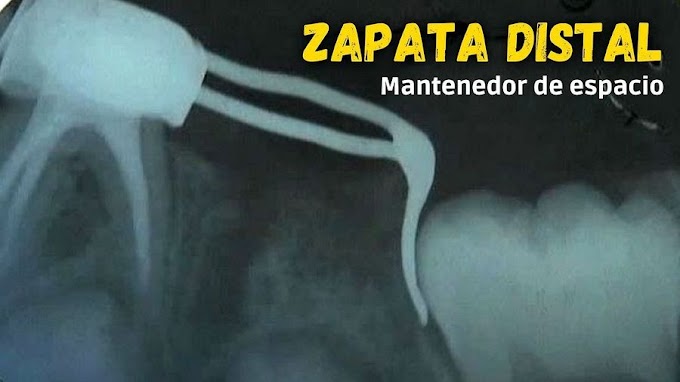 MANTENEDOR DE ESPACIO: Colocación de Zapata Distal por la pérdida prematura de una segunda molar temporal