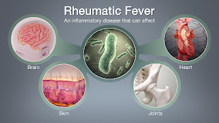 Rheumatic fever Symptoms and Causes