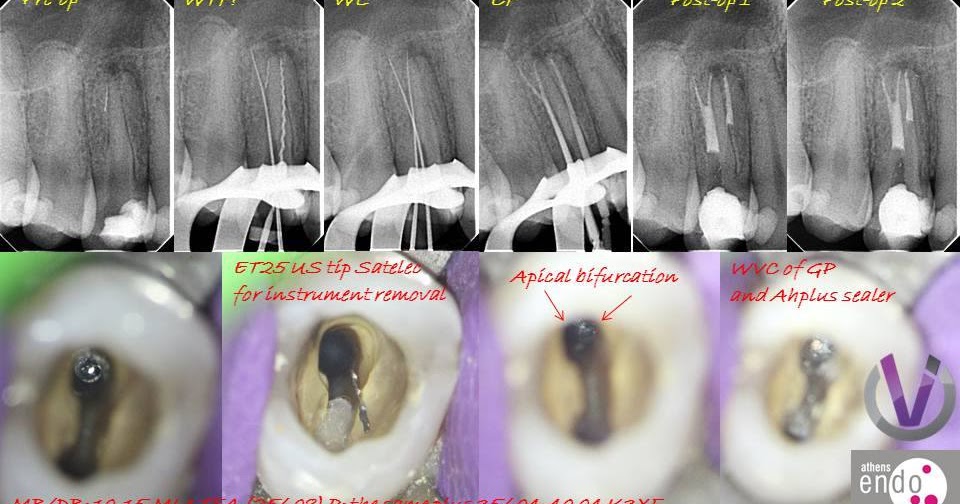 The Root Canal Anatomy Project: Three-Rooted Maxillary Premolar