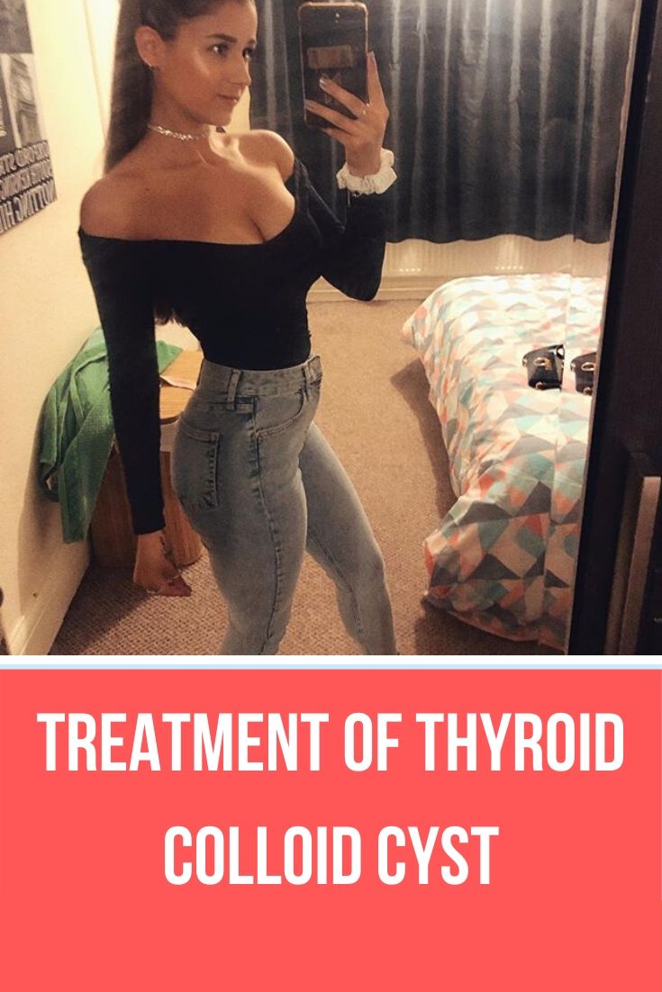 Treatment Of Thyroid Colloid Cyst