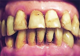 <Img src ="Tinción_por_Clorhexidina.gif" width = "270" height "190" border = "0" alt = "Imagen de coloración amarilla de dientes y lengua por clorhexidina.">