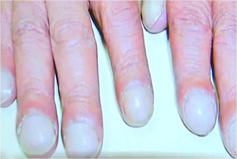 modern-diagnostic-science-can-your-nails-identify-cancer-by-dr