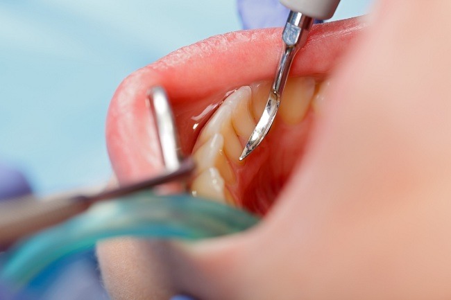 Apa Saja Efek Karang Gigi dan Cara Mencegahnya?