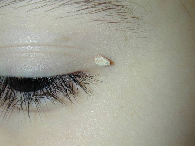 Eyelid lump and Warts - Symptom Checker - check medical ...