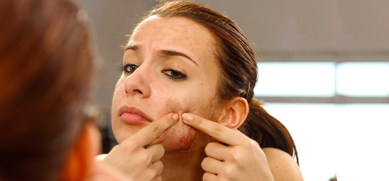 Acne Vulgaris, commonly referred to as acne, is really a skin issue plaguin...