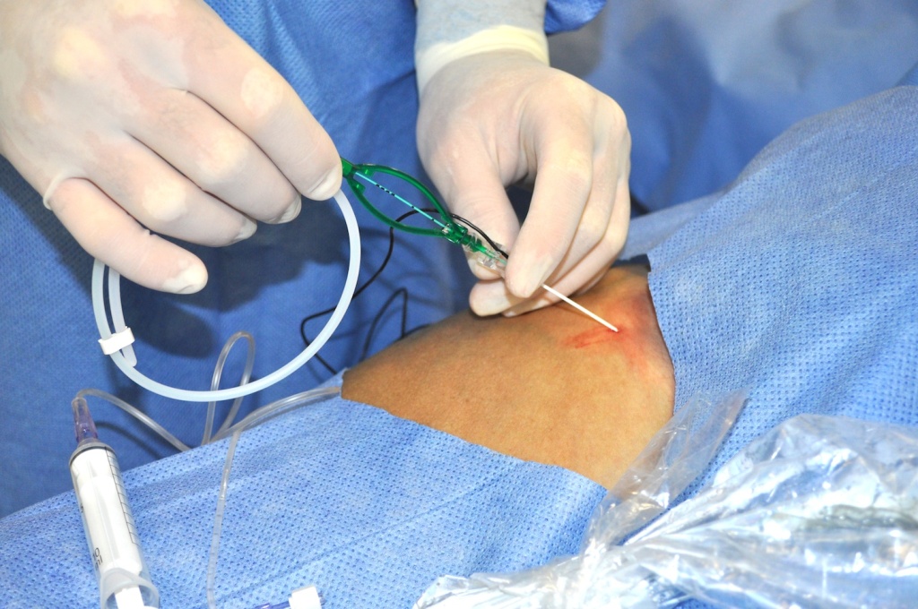 EmergencyMedJC Femoral Nerve Catheters Improve Home Disposition and