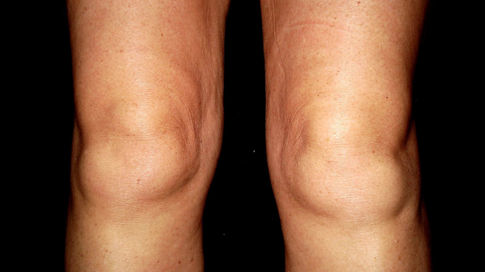 Swollen Behind The Knee - Knee Choices