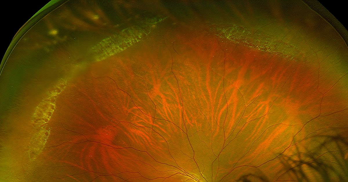 Sonoran Desert Eye Center SNAILTRACK LATTICE DEGENERATION