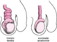 CARA CEPAT MENGATASI NYERI PADA TESTIS