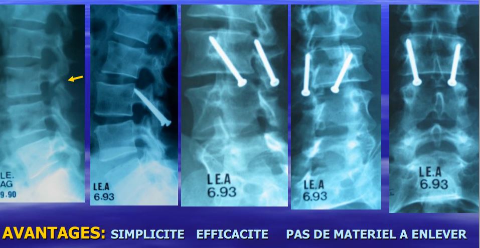 Antélisthésis De L5 Sur S1 Par Lyse Isthmique
