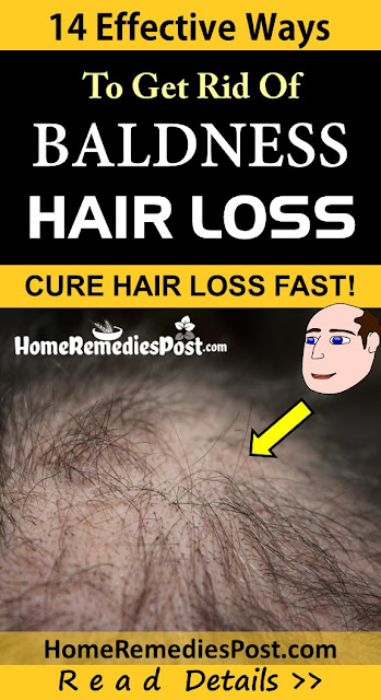 Home Remedies for Baldness, How To Get Rid Of Hair Loss, How To Get Rid Of Baldness, how to stop hair loss,